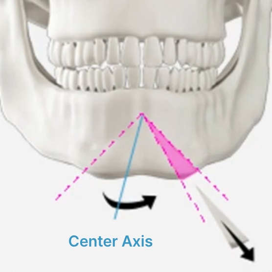 Facial Contouring Seoul - THE PLAN Plastic Surgery Korea