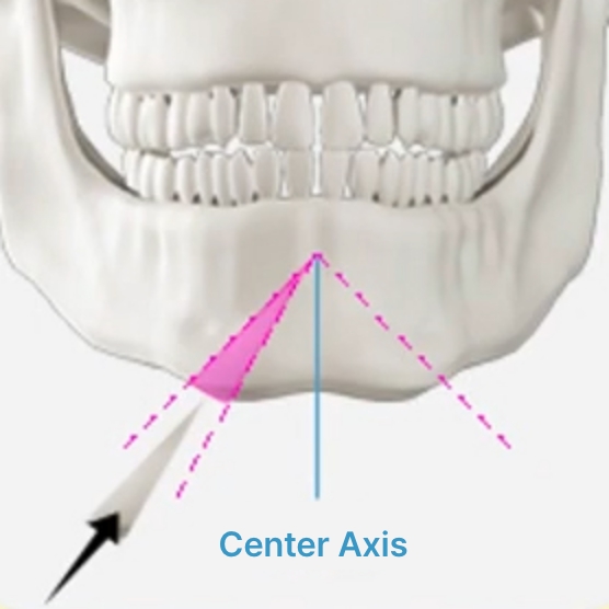 Facial Contouring Seoul - THE PLAN Plastic Surgery Korea