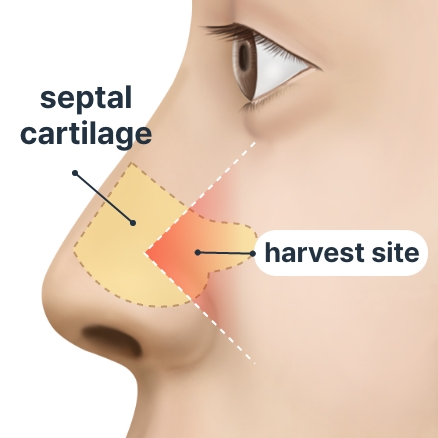 Rhinoplasty Seoul - THE PLAN Plastic Surgery Korea